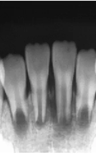 Figura 8: radiografia tirada 19 dias após a primeira consulta. Espessamento do ligamento periodontal teria  aumentado (Iwaya, et al
