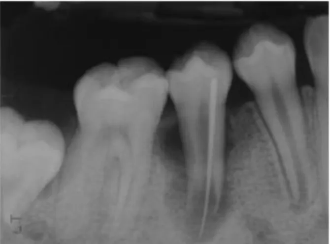 Figura  2:  Radiografia  a  mostrar o rastreio  da  fístula  lingual  com  cone  de  gutta-percha  (Banchs &amp; Trope, 2004)