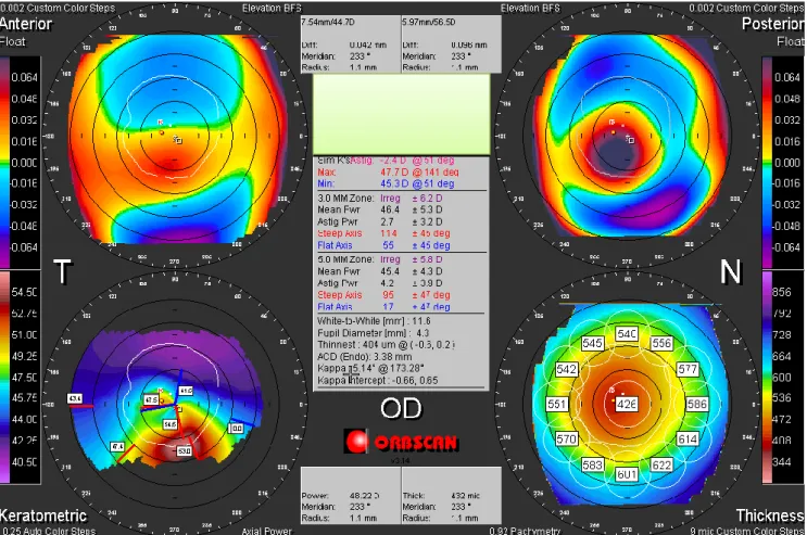 Figura 10 – Orbscan do Olho Direito. 