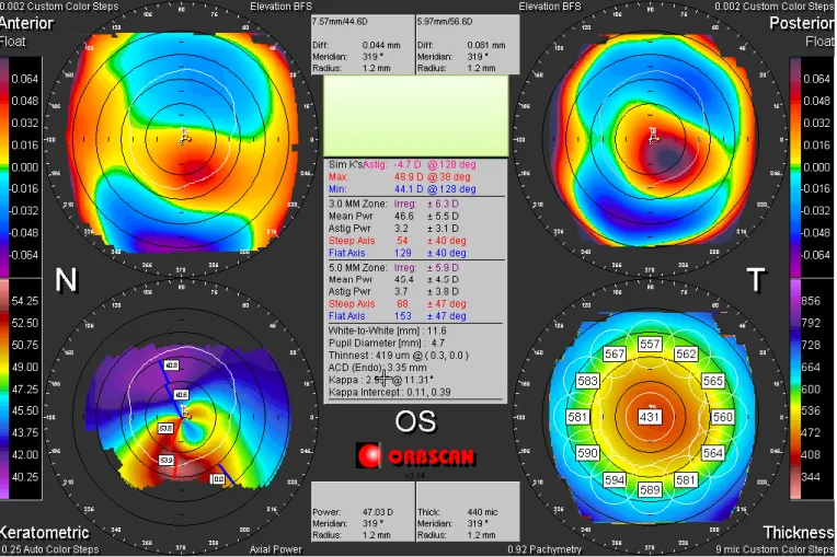 Figura 12 – Orbscan do OE. 