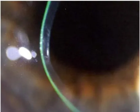 Foto 8 – Adelgaçamento corneal 