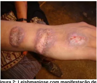 Figura 2: Leishmaniose com manifestação de  lesões ulceradas múltiplas 1