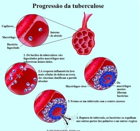 Figura 6 - Evolução da tuberculose 6
