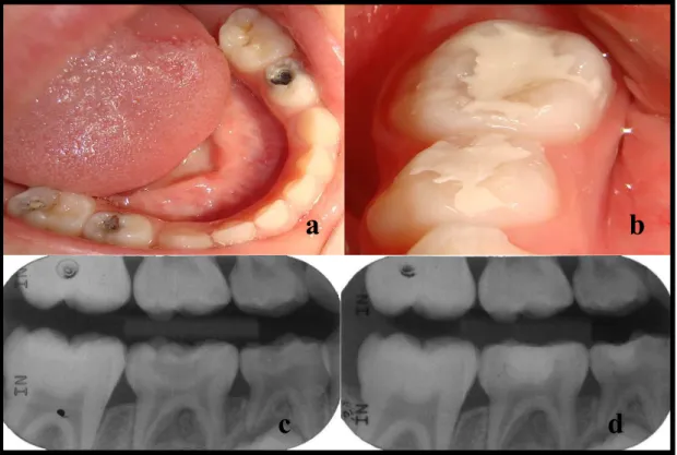 Figura 1: a – Fotografia clínica mostrando as lesões de cárie em superfície oclusal de  molares  decíduos