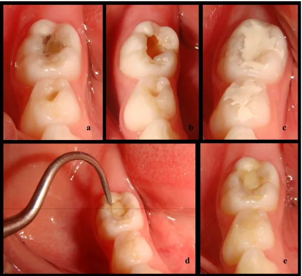 Figura 1 - Fotografias clínicas evidenciando: a) lesão de cárie oclusal no dente 85; b)  aspecto do preparo do dente após a remoção parcial do tecido cariado; c) restuaração em  ionômero de vidro, no tempo 0; d) avaliação clínica da restauração após 3 mese