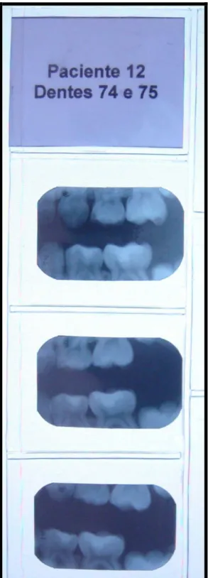 Figura  2  –  Fotografia  da  cartela  plástica  contendo  a  identificação  do  paciente  e  dos  dentes e as três radiografias interproximais nos tempos 0, 3 e 6 meses