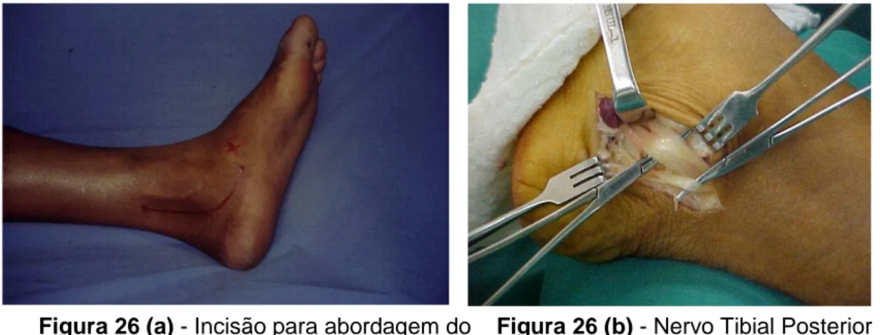 Figura 26 (a) - Incisão para abordagem do    Figura 26 (b) - Nervo Tibial Posterior  