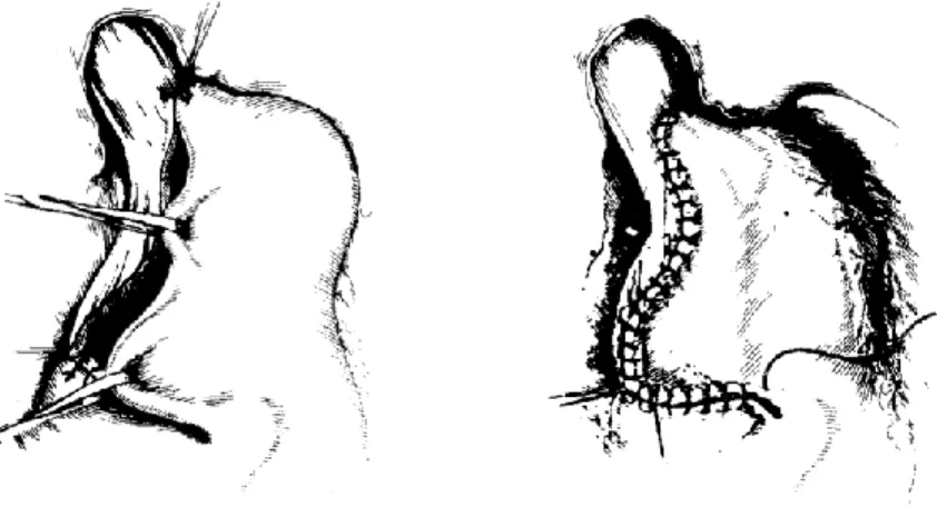 Fig. 4- Sutura do fundo gástrico às bordas da esofagotomia, fechando a brecha esofágica 
