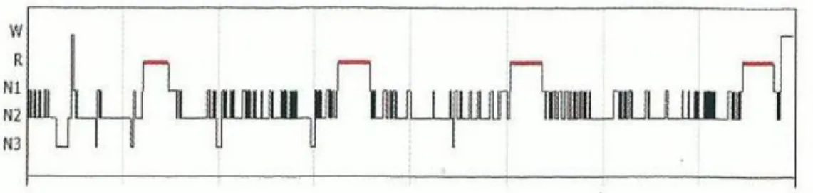 Figura  9:  Hipnograma  de  fragmentação  do  sono  de  um  paciente  com  apneia  do  sono  (Adaptado de Martins, 2011)