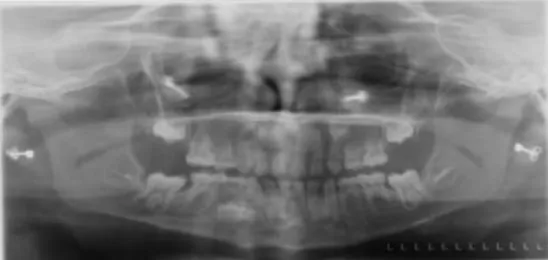 Figura 6 – Ortopantomografia de Paciente portadora de Displasia Ectodérmica. 