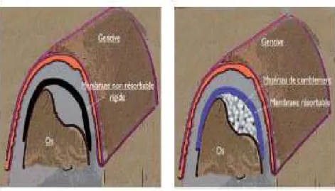 Figure  5:  Guided  bone  regeneration  with  bone  substitute  (right)/without  bone  substitute  (left) (Nevins, 2010) 