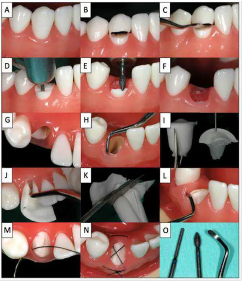 Figure 7:The step by step procedure illustrated on a model (Glocker et al., 2014) 