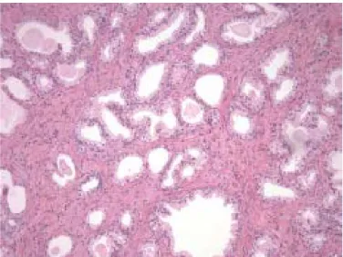 Figure 3- Benign prostatic hyperplasia, H&amp;E staining. Microscopic image of a small gland pattern area of  benign  nodular  hyperplasia,  composed  by  small  to  medium-sized  and  irregular  acini,  with  rounded  lumens and surrounded by stroma