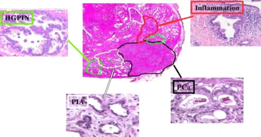 Figure  6-  The  distribution  of  inflammation,  PIA,  HGPIN  and  PCa  in  the  human  prostate  H&amp;E  staining  tissue  sample,  indicated,  respectively,  by  red,  white,  green  and  black  lines  and  arrows