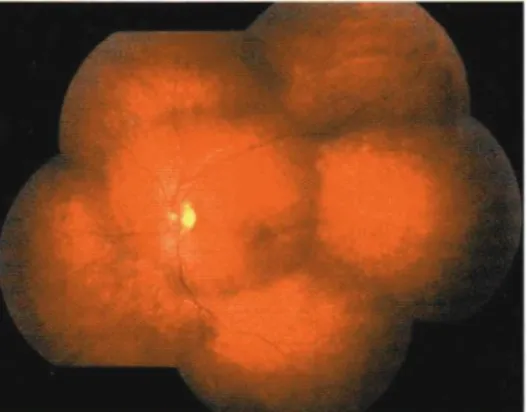 Figura 10 - Injecção da fluoresceína na veia antecubital e tempo de circulação braço-retina  (Kansky, 2007 [31])