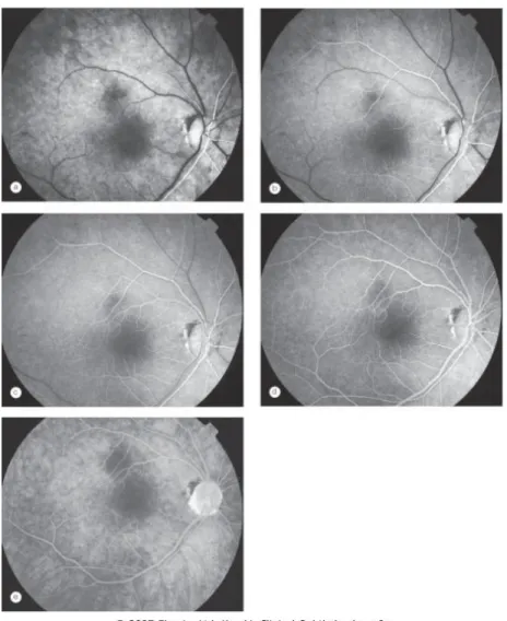 Figura 12 - Fases da angiografia fluoresceiníca em olho sem anomalias, (Kansky, 2007 [31])