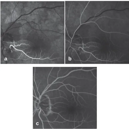 Figura 15 – Sequência das três primeiras fases da angiografia fluoresceínica, (Dithmar et al,  2008 [32])