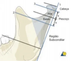 Figura 1 – Relação anatómica entre cabeça,  colo e região  subcondilar (adaptado AO Foundation, cit