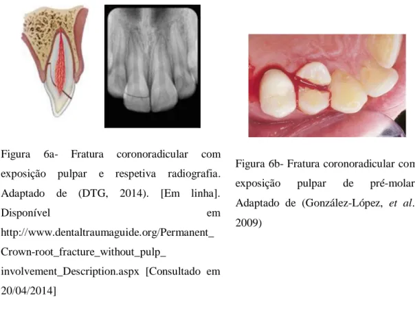 Figura 6b- Fratura coronoradicular com  exposição  pulpar  de  pré-molar. 