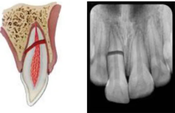 Figura 8- Esquema  ilustrativo  de fratura alveolar, respetiva radiografia e imagem  em  inspeção  intra-oral