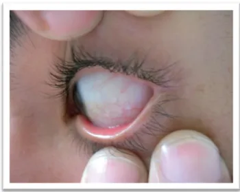 Figura I-8: Manifestações oculares (Adaptado de  8 ).  Dilatações e tortuosidades vasculares  na conjuntiva inferior do olho de um doente portador da DF 8 