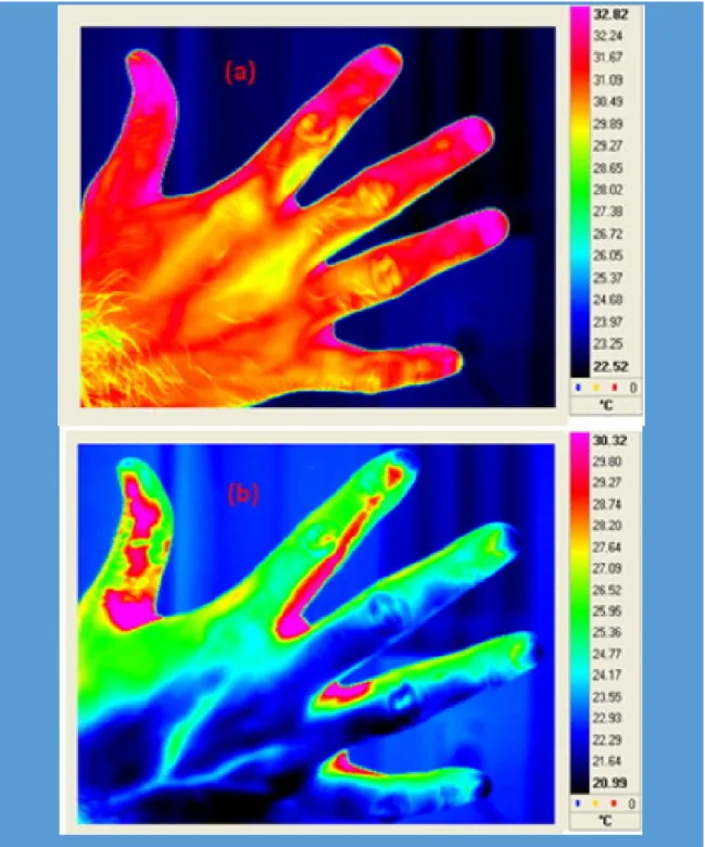 Figura 2.7.1 - a) Imagem térmica típica da mão de um indivíduo normal antes do estimulo frio