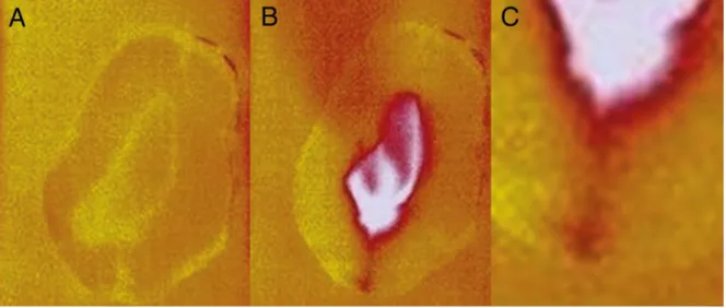 Figura 2.9.2 – A) raiz antes da vibração com destartarização; B) microfissura dentinária detetada  pelo aumento da temperatura, C) Ampliação da imagem da fissura (Manami et al