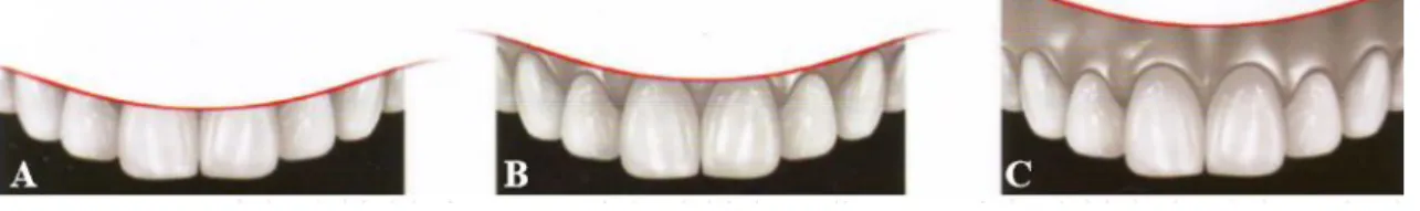 Figura 1: A - linha labial baixa; B - linha labial média; C - linha labial alta. Retirado e  adaptado de: “Invisible – Restauraciones Estéticas Cerámicas” (Kina &amp; Brugera, 2008)    A grande maioria dos dentistas consideram que, durante o sorriso, o láb