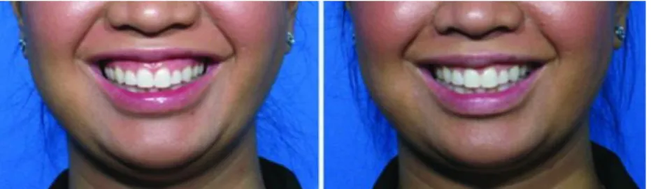 Figura  3:  Toxina  botulinica  A  usada  no  tratamento  do  sorriso  gengival.  Retirado  e  adaptado: “BOTOX: Broadening the Horizon of Dentistry” (Nayyar et al.,2014)