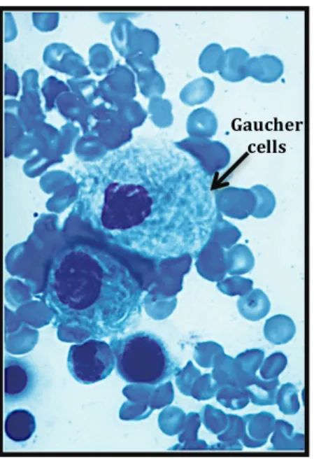 Figure    5    -­‐    Gaucher    cells    from    a    bone    marrow    aspirate.    These    cells    derive   from   macrophages   with   stored   glycolipids