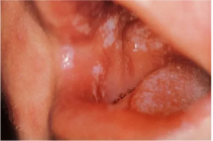 Figura 8: Candidíase pseudomembranosa aguda na mucosa jugal e língua (adaptado de Laskaris, 2000)