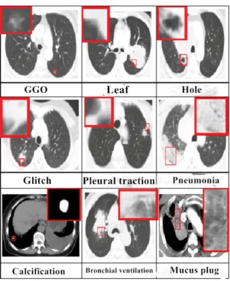 Figure 1: Examples of common nine types of signs annotated on lung CT (Han, 2014)