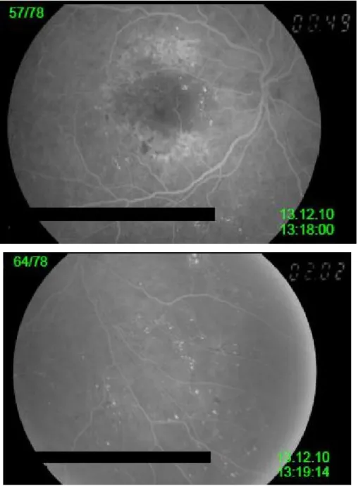 Figura 3.3 - Angiografia Fluoresceínica realizada ao OD na fase venosa capturada aos 49s e aos 122s em  Dezembro de 2010 (26)