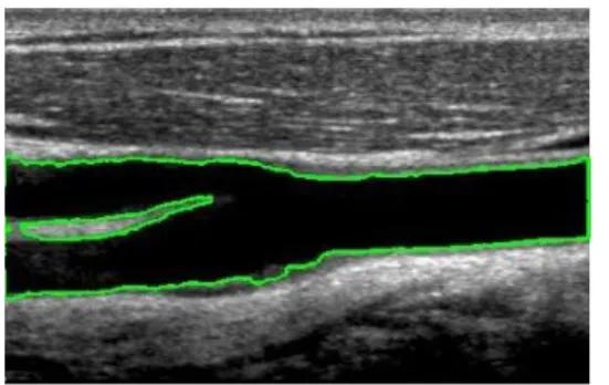 Figura 6 Resultado da aplicação do algoritmo de Chan Vese  (Level Set) à imagem da bifurcação da carótida