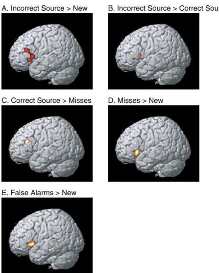 Fig. 2. Activations in the left ventro-lateral frontal region/frontal operculum and left dorsal inferior frontal region