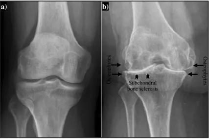Figure 2.9- X-ray comparison of: a) normal knee; 