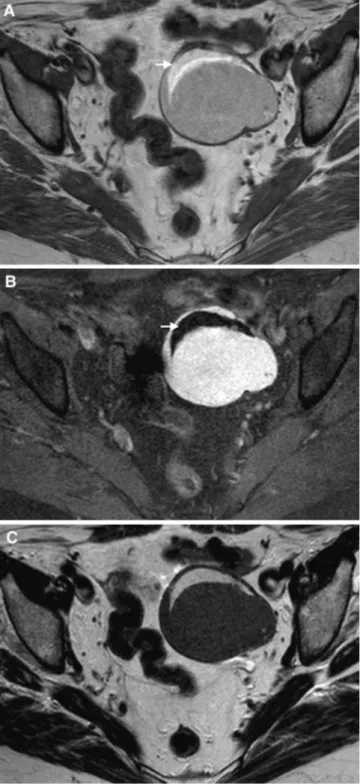 Fig. 4. MRI of a serous adenofibroma of the left ovary in a 71-year-old woman. A Axial T1WI reveals a cystic  hyperin-tense lesion