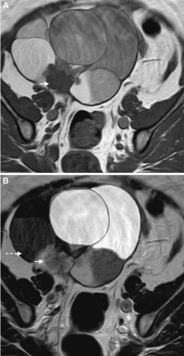 Fig. 5. MRI of a mucinous borderline tumor within an endometrioid cyst of the right ovary in a 50-year-old woman.