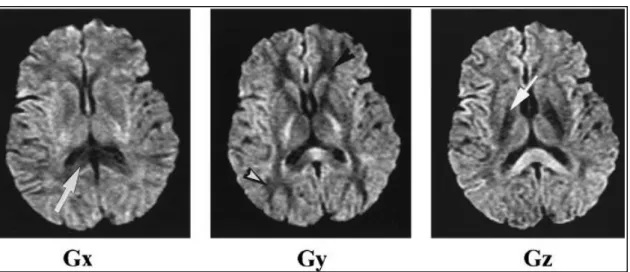 Figura 6:  Natureza anisotrópica do cérebroA) EPI imagem potenciada em difusão (b = 1000 s/mm2)B) Angio-RM sem contraste