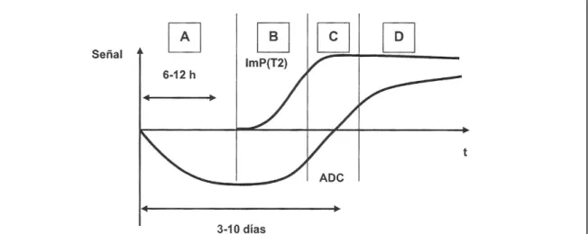 Figura 11:   Esquema representativo da evolução com o tempo depois de um AVC agudo  dos valores de ADC e do sinal em imagens ponderadas em T2.