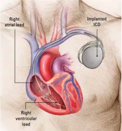 Figure 2.3: Human chest representation with an implanted ICD (top right, near shoulder) and electrical leads connected to heart chambers.