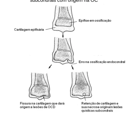 Figura 5 – Diagrama da patogénese da Osteocondrite Dissecante (OCD) e dos quistos  subcondrais com origem na OC 