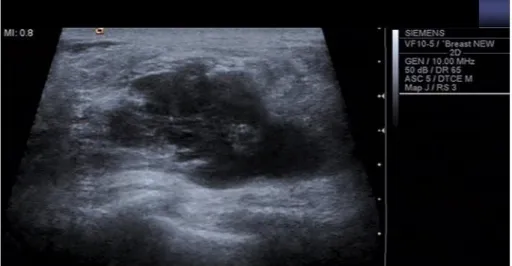 Figura 1.1: Exemplo de imagem de ultrasons peitoral (modo B).