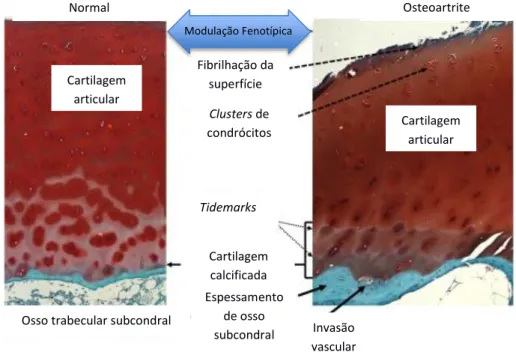 Figura 3: Comparação entre cartilagem normal e com osteoartrite (adaptado de Goldring,  2012)