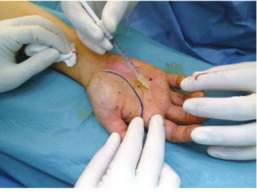 Figura   9   –   injeções   intradérmicas   na   região    palmar   após   bloqueio   anestésico   regional   