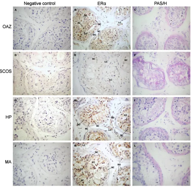 Figure  2.2 Immunohistochemical  localization  of  ERα  adult  human  testis  from  patients  with  secondary  obstructive  azoospermia  (OAZ),  Sertoli  cell-only  syndrome  (SCOS),  hypospermatogenesis  (HP) and meiotic arrest (MA)