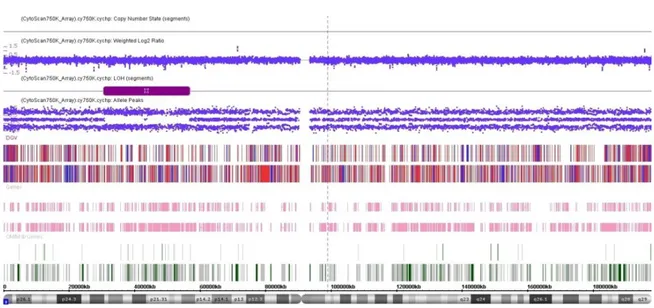 Figura  19.  Resultado  da  análise  cromossômica  por  microarray  na  plataforma  Cytoscan  750k  (Affymetrix)