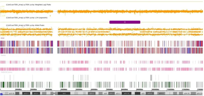Figura  20.  Resultado  da  análise  cromossômica  por  microarray  na  plataforma  Cytoscan  750k  (Affymetrix)