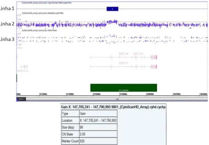 Figura  8:  Resultado  da  análise  cromossômica  por  microarray  na  plataforma  Cytoscan  HD  (Affymetrix @ )