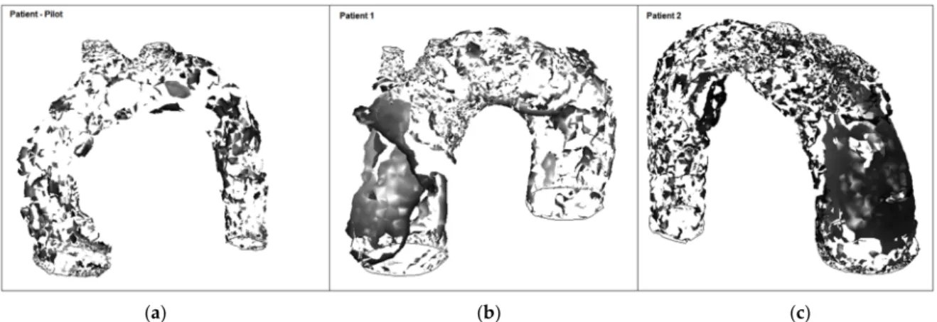 Figure 18. Formation of vortical structures (at peak systole): (a) Patient-pilot; (b) Patient 1; (c) Patient 2